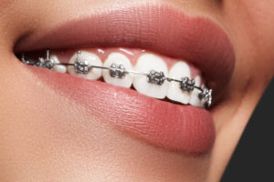 orthodontic treatment